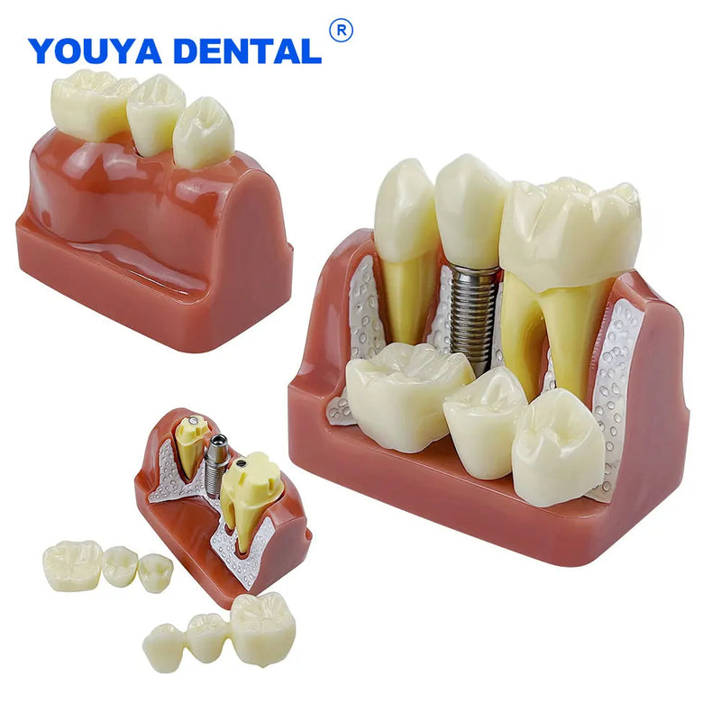 Modelo de Ensino/Estudo/Treino para Implante Dental - com Coroa, Ponte Removivéis